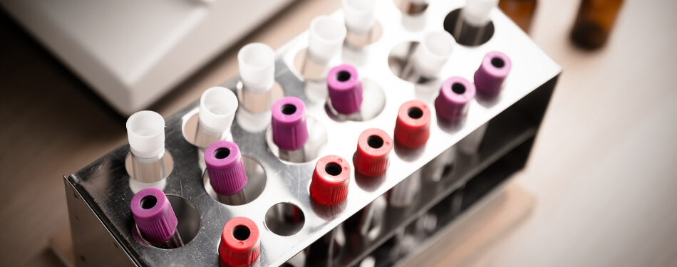 Laboratory sample of blood testing for Hepatitis C diagnosis.