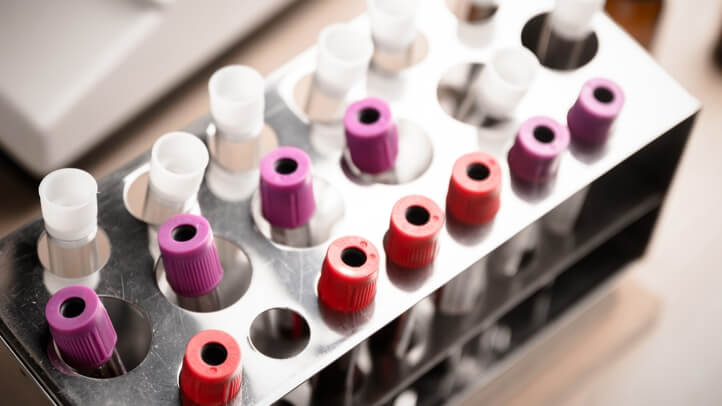 Laboratory sample of blood testing for Hepatitis C diagnosis.