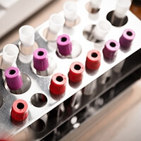 Laboratory sample of blood testing for Hepatitis C diagnosis.